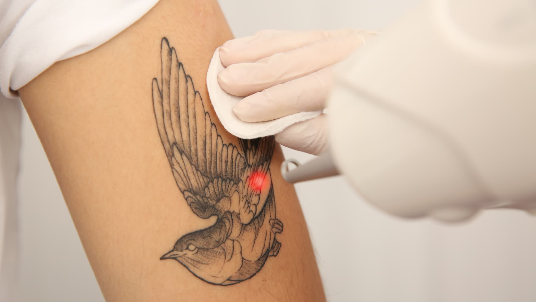Laser Tattoo Removal treatment at BC Medical Clinic